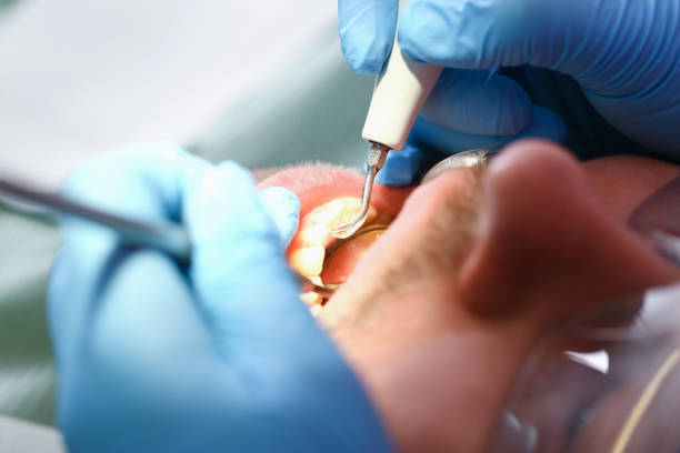 Best Emergency Tooth Extraction in Eidson Road, TX